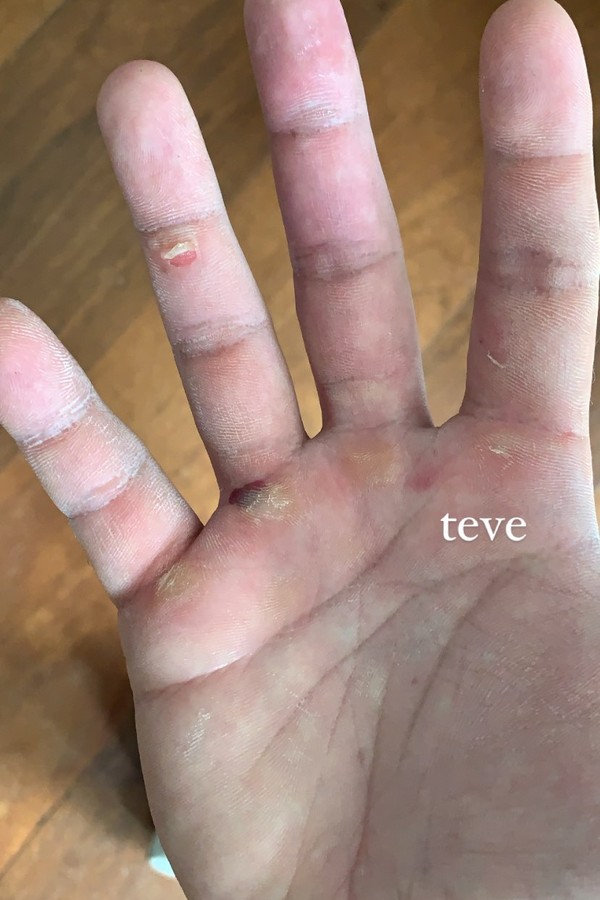 Chay mostra resultado dos calos nas mãos após treino (Foto: reprodução/Instagram)