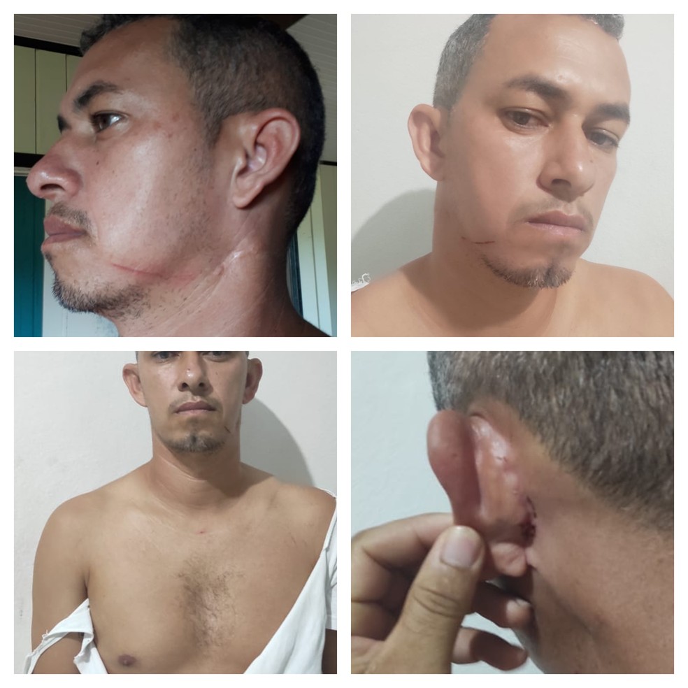 Policial Da Cruz mostra os ferimentos que, segundo ele, foram causados pelas agressões da primeira dama e prefeito da cidade  — Foto: Arquivo pessoal 