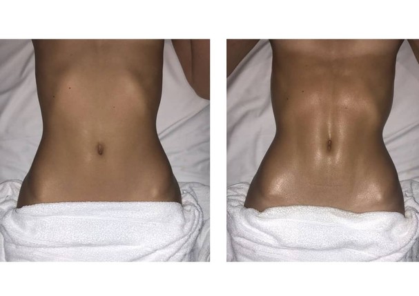 Bruna Marquezine mostra antes e depois de massagem modeladora (Foto: Reprodução/Instagram)