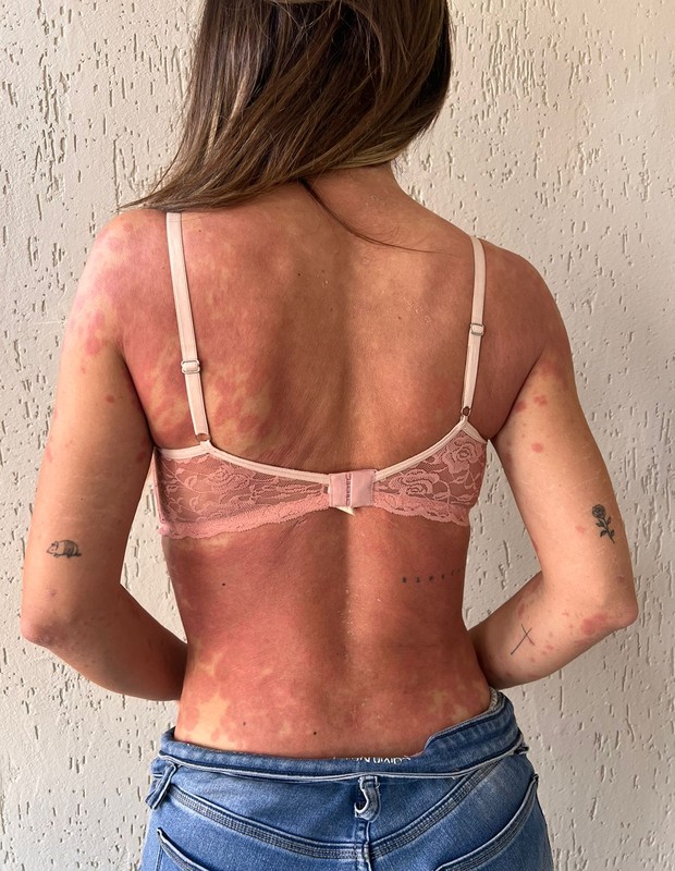 Letícia Santiago mostra evolução das manchas pelo corpo (Foto: Arquivo pessoal)