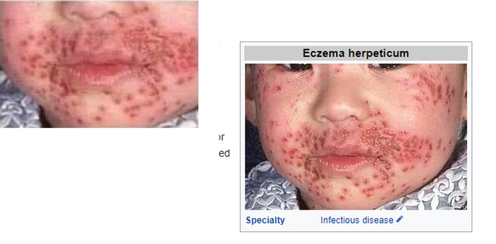 Imagem de criança mostra lesão por eczema herpético e não por uso de máscara  — Foto: Reprodução