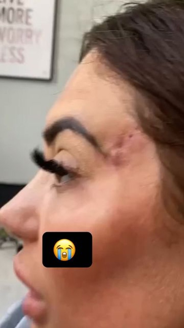 Chloe Ferry se submeteu a um procedimento chamado foxy eye, que deu errado (Foto: Reprodução / Instagram)