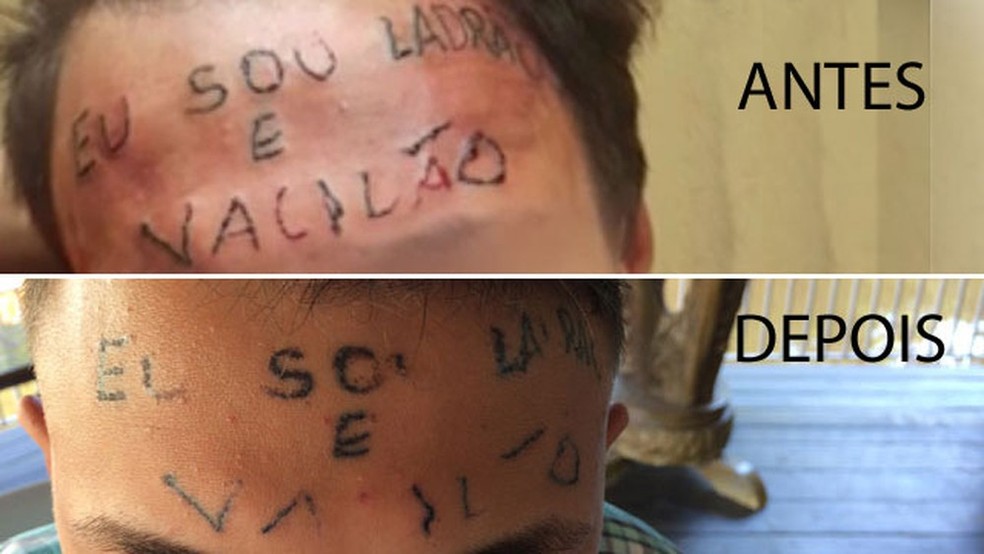 RemoÃ§Ã£o de tatuagem feita por dupla presa por tortura de jovem em SÃ£o Bernardo (Foto:  Glauco AraÃºjo/G1)