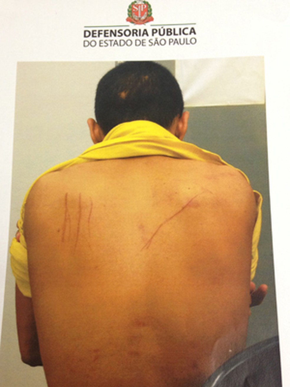 Adolescente interno da Fundação Casa com marcas de agressão — Foto: Defensoria Pública