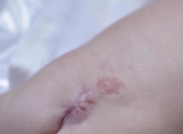 Cicatriz da mielo na colua de Enzo (Foto: Samantha Agiessi)