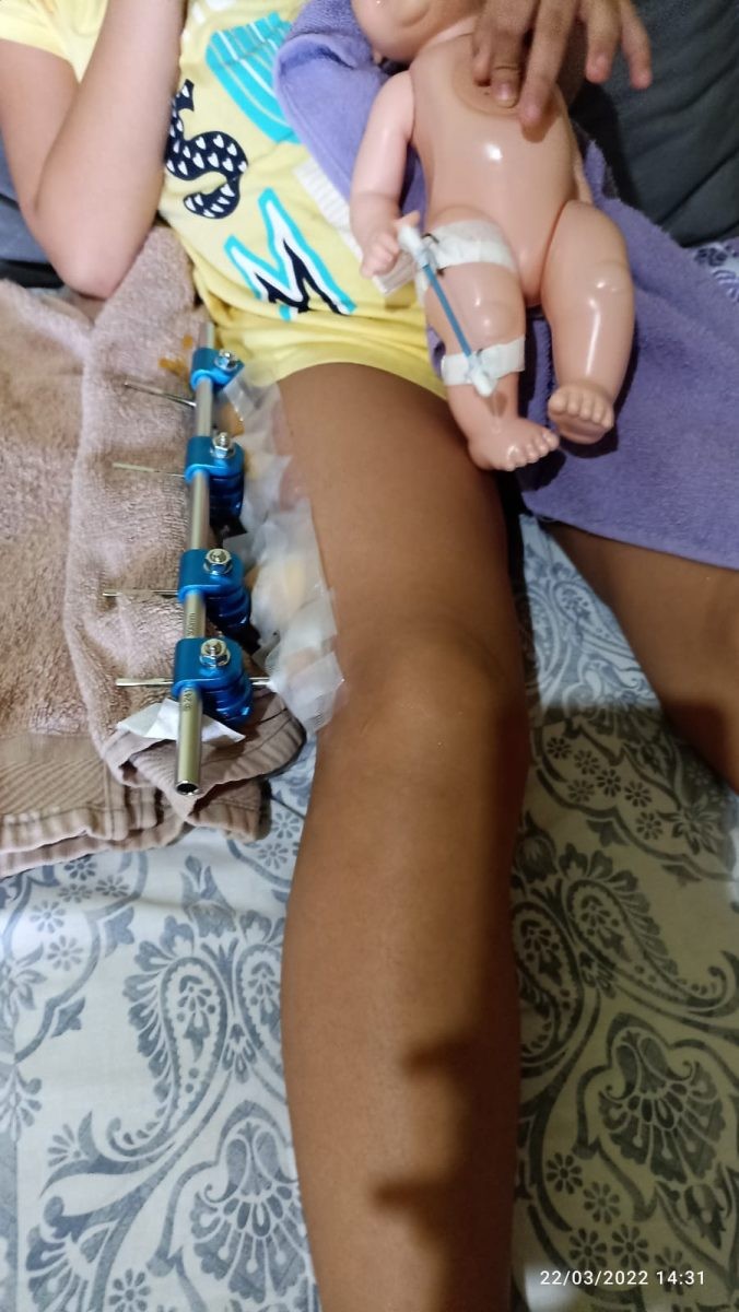 Menina de 4 anos tem perna quebrada após banco de praça desabar em Várzea Grande (MT)