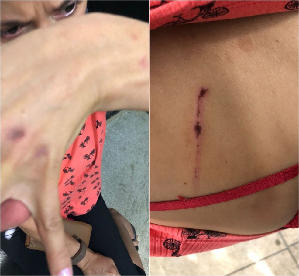 Servidora sofreu hematomas pelo corpo — Foto: Reprodução