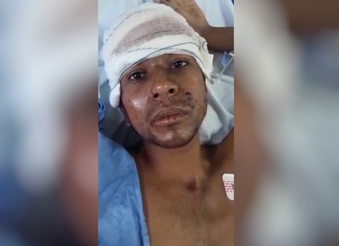 Homem tem rosto cortado em ataque de pitbull em Fortaleza: 'Muito violento' 