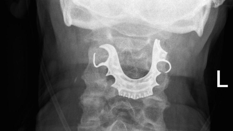 MÃ©dicos encontraram dentadura de homem em sua garganta oito dias apÃ³s cirurgia no abdÃ´men â€” Foto: DivulgaÃ§Ã£o/BMJ Case Reports 2019