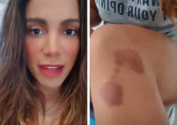 Anitta revela que tomou "esporro" da médica após tombo (Foto: Reprodução/Instagram )