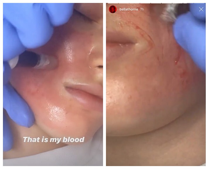 A atriz Bella Thorne com o rosto ensanguentado em meio ao seu tratamento de pele (Foto: Instagram)