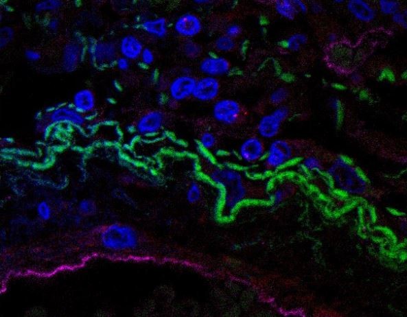 No tecido pulmonar de um indivíduo que morreu após contrair a COVID-19 é possível visualizar em algumas células inflamassomas ativos (punctas), representados pelos pontos vermelhos. A cor verde marca as fibras de colágeno, enquanto a azul, os núcleos das células pulmonares. A cor rosa representa as células epiteliais. (Foto: Keyla S. G. de Sá/FMRP-USP)