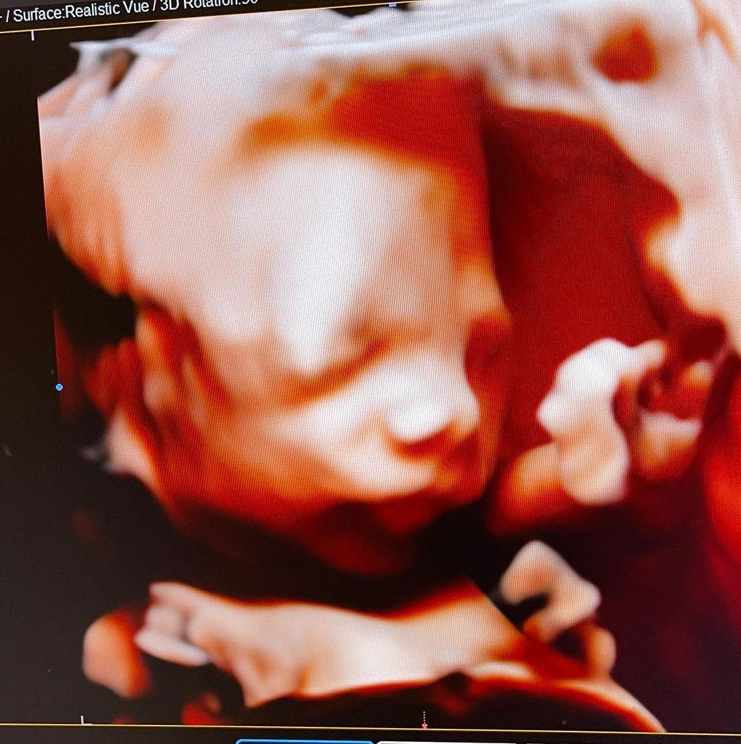 Maria Alice vista pelo ultrassom 3D (Foto: Reprodução/Instagram)