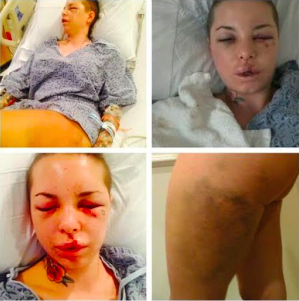 Os ferimentos de Christy Mack em decorrência dos ataques de Jonathan ‘War Machine’ Koppenhaver (Foto: Reprodução)