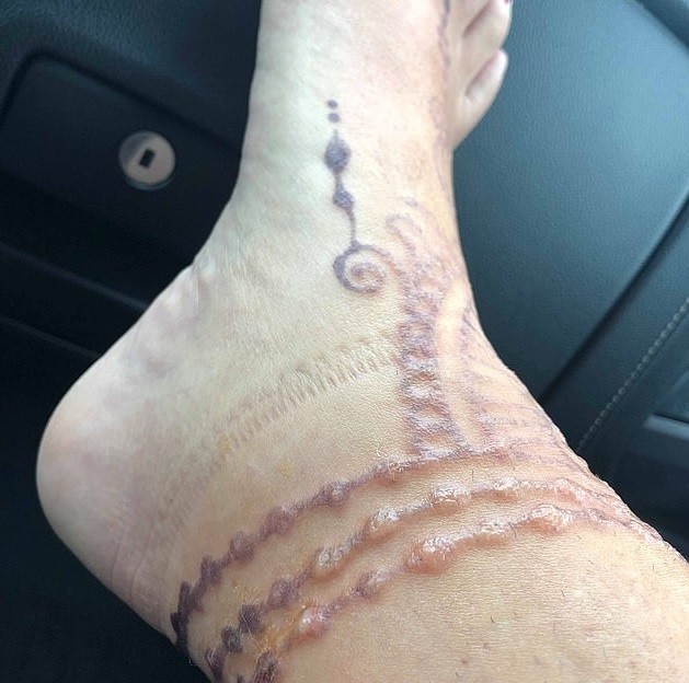 Mulher sofre com alergia depois de fazer tatuagem de henna nas férias (Foto: Reprodução )