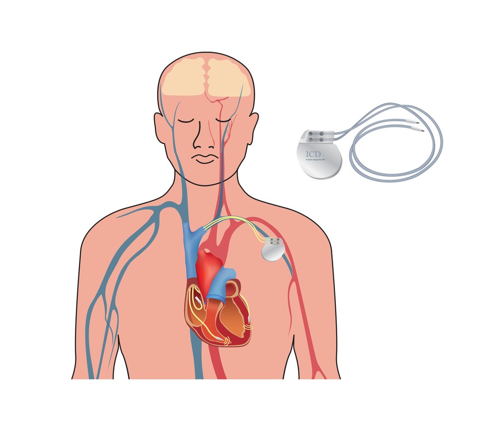 Cardiodesfibrilador interno  — Foto: Istock Getty Images