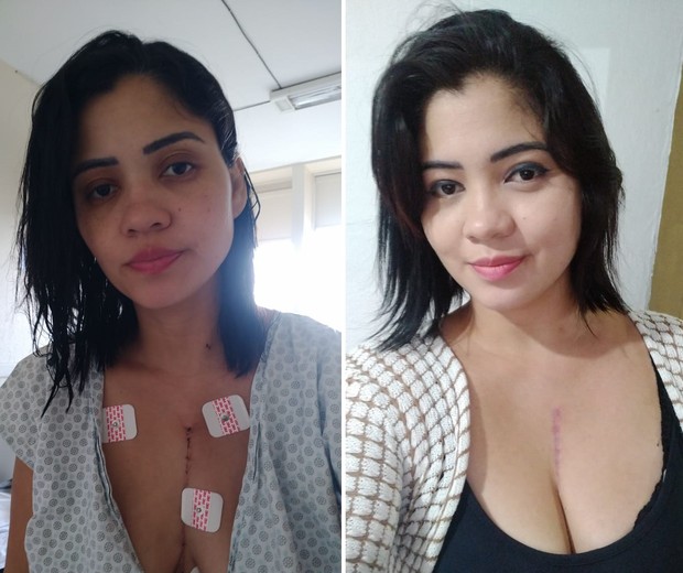 Paloma após a cirurgia e hoje, três meses depois (Foto: Arquivo pessoal)