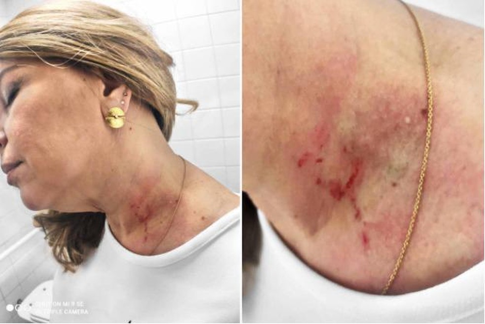 Vereadora Cris Monteiro (Novo) divulgou em suas redes sociais os ferimentos que sofreu durante a briga com a colega de partido. — Foto: Reprodução 