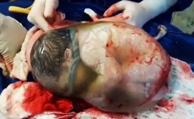 Bebê dentro do saco amniótico (Foto: Reprodução)
