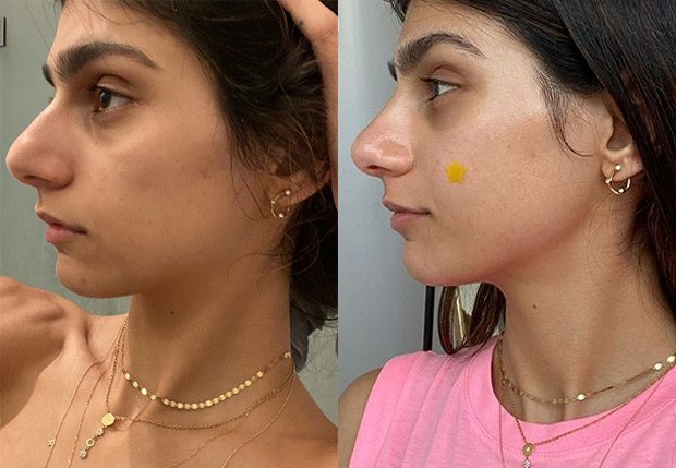Mia Khalifa mostra resultado após cirurgia no nariz; compare - Quem | QUEM  News