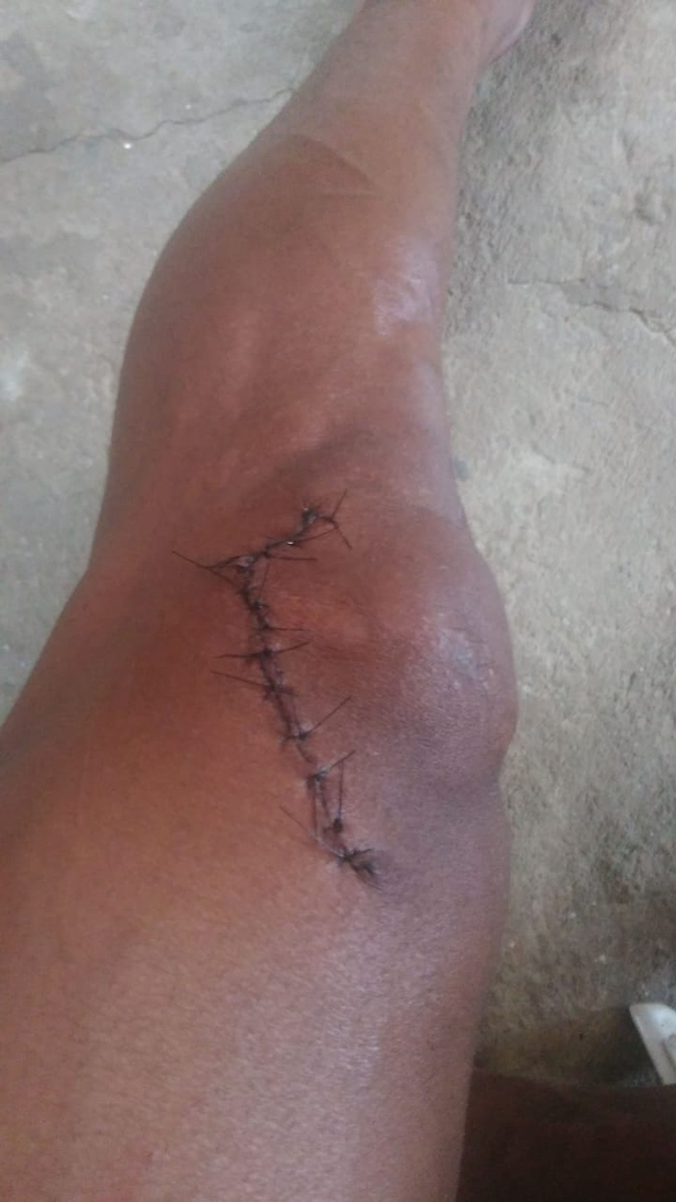 Jogador do Friburguense levou 14 pontos na perna apÃ³s cair em uma moita no EstÃ¡dio AlzirÃ£o â€” Foto: Arquivo pessoal