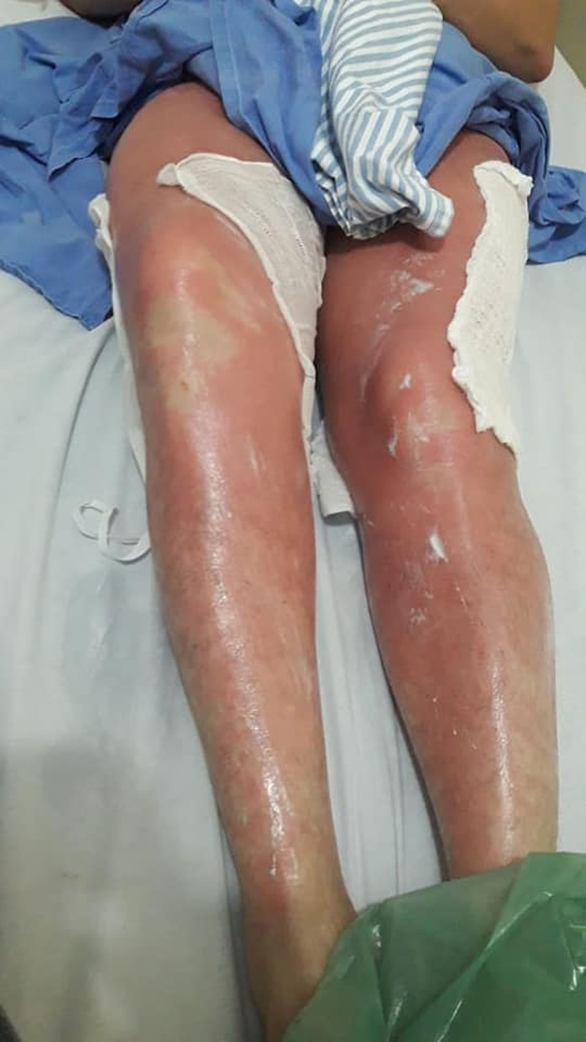 Mulher Tem Queimaduras De 3Âº Grau E Esta Em Estado Grave Apos Se Bronzear Com Cha De Folha De Figo Em Mt Mato Grosso G1