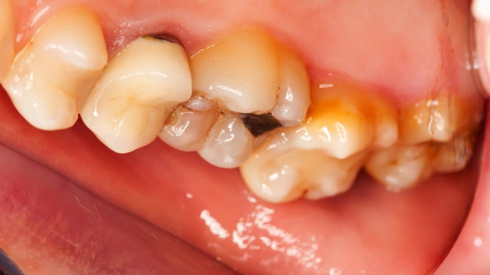 Erosão dentária pode causar perda de dentes (Foto: Getty Images)