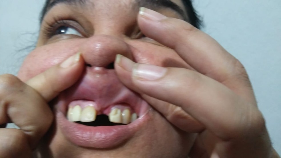 Cantora ficou impossibilitada de trabalhar, pois sente fortes dores e teve o freio labial costurado — Foto: Arquivo pessoal