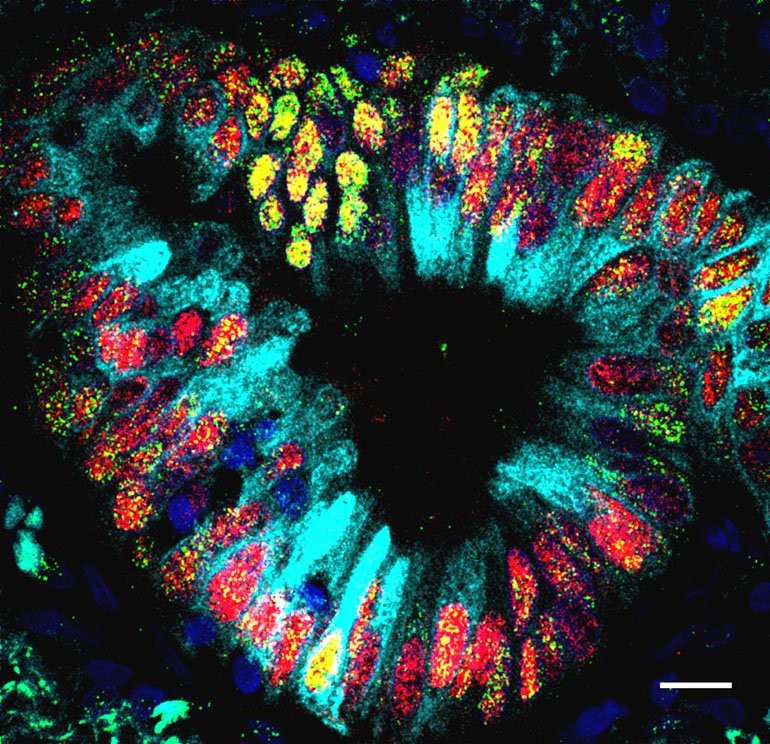 Cientistas dizem ter encontrado estruturas muito similares a um pequeno estômago entre as células de um tumor pulmonar (Foto: Tata Lab/Universidade Duke)