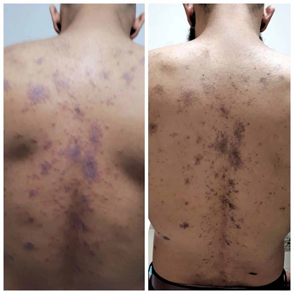 carioca tenta superar problema de pele e depressao com ajuda da corrida corrida eu atleta ge