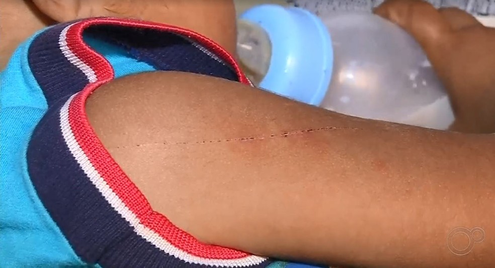 Menino ficou com braço machucado após pipa com linha cortante cair em quintal — Foto: Reprodução/TV TEM
