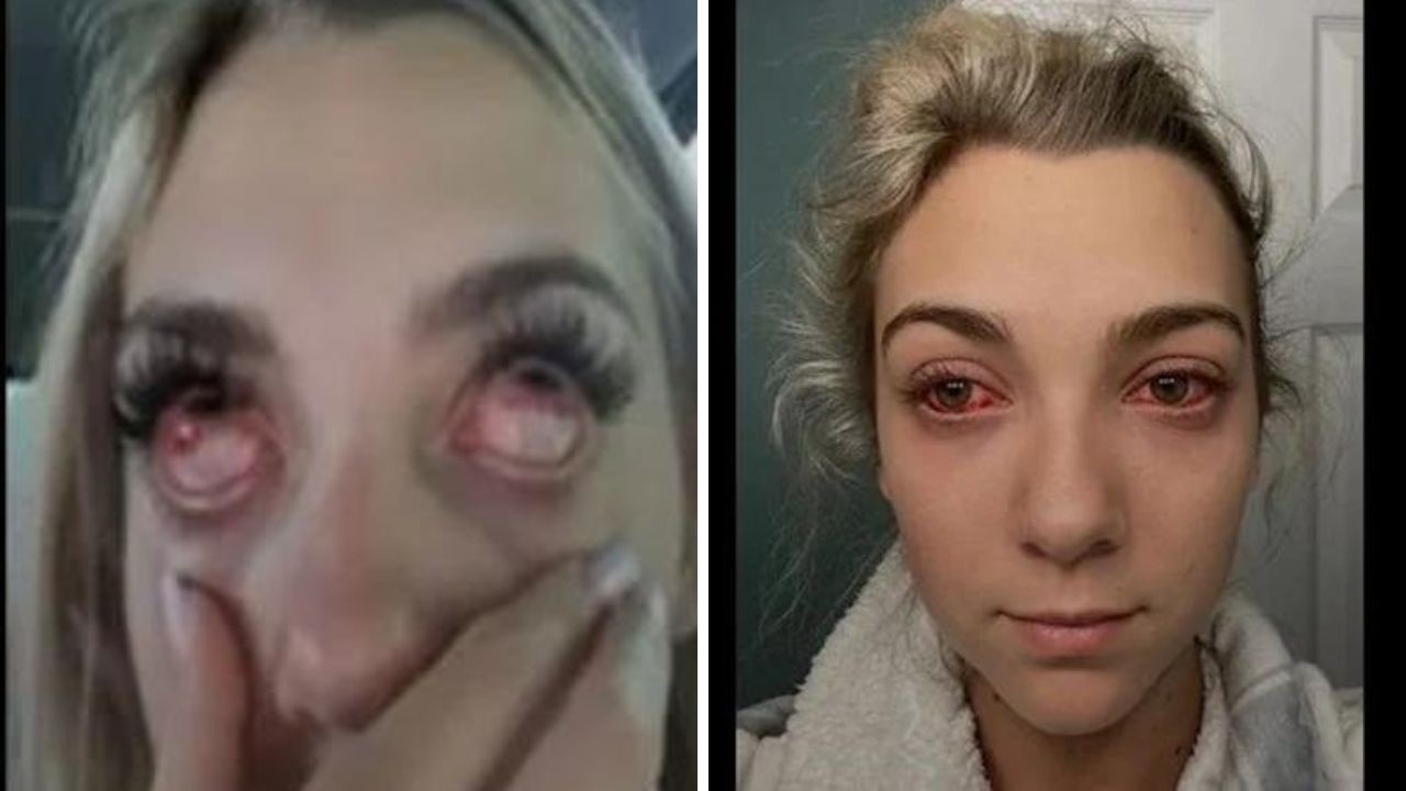 Haley Fetzer disse ter ficado com "olhos de zumbi" depois de ter feito o procedimento estético (Foto: Reprodução)