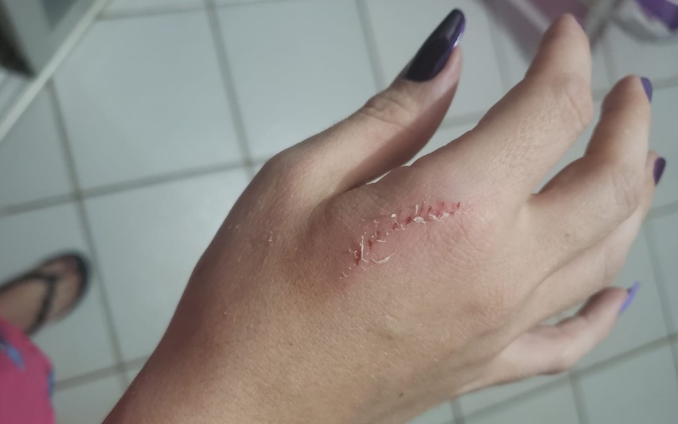Machucado na mão de médica enquanto ela tentava proteger amigo de ser agredido por ex-namorado dela — Foto: Reprodução/TV Anhanguera