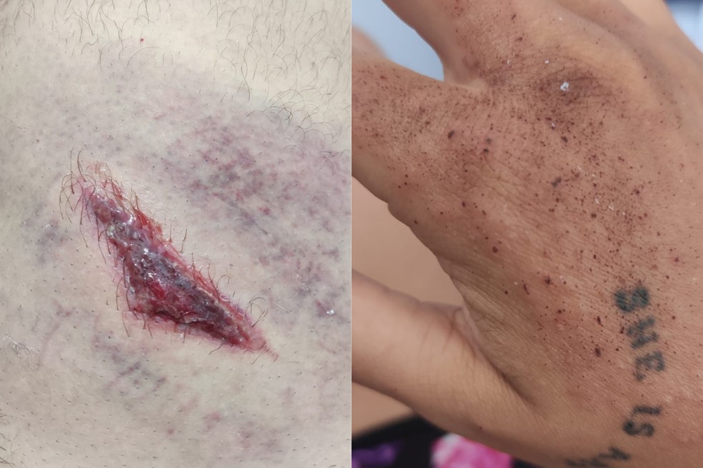 Pedagoga sofreu queimadura na mão e a esposa dela teve ferimento causado pelo fogo de artifício na coxa — Foto: Arquivo Pessoal