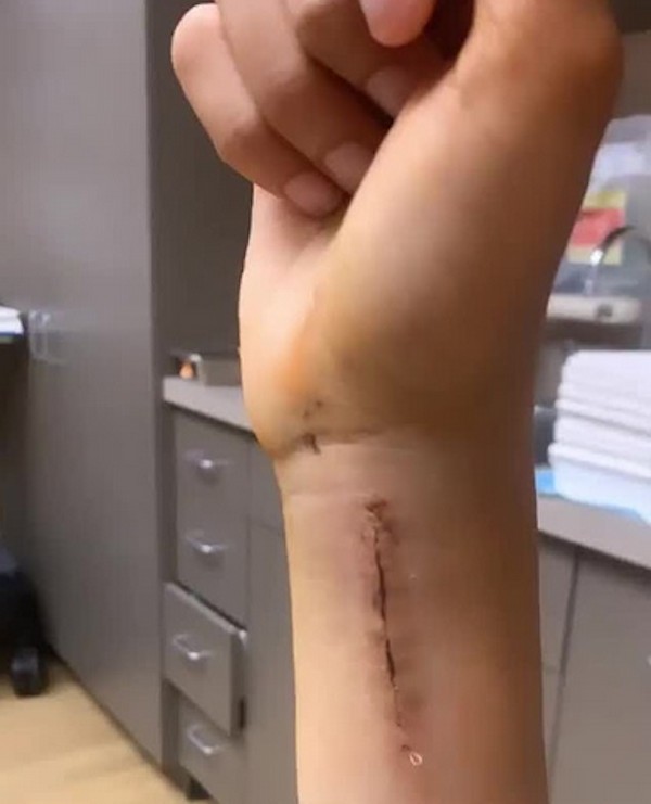 A cicatriz no braço da modelo sueca Kelly Gale decorrente de uma queda de cavalo (Foto: Instagram)