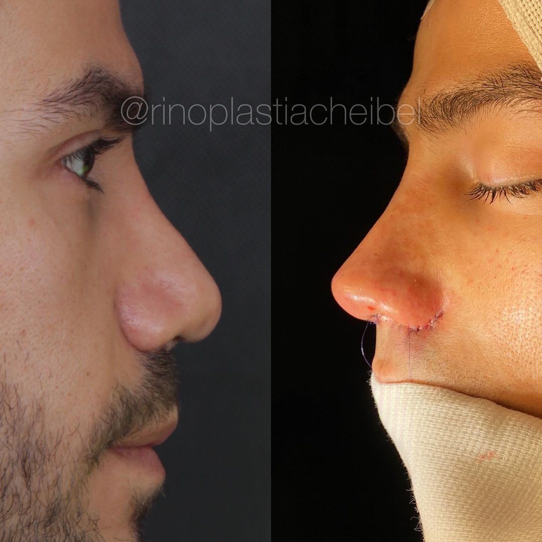 Jakelyne e Mariano mostram resultado de rinoplastia (Foto: Reprodução/Instagram) Jakelyne e Mariano mostram resultado de rinoplastia (Foto: Reprodução/Instagram)
