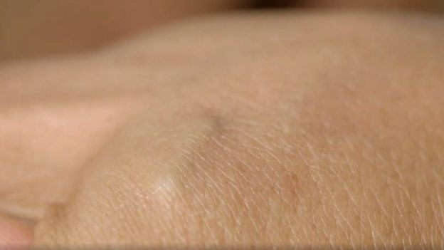O microchip é implantado debaixo da pele, entre o polegar e o indicador (Foto: BBC)