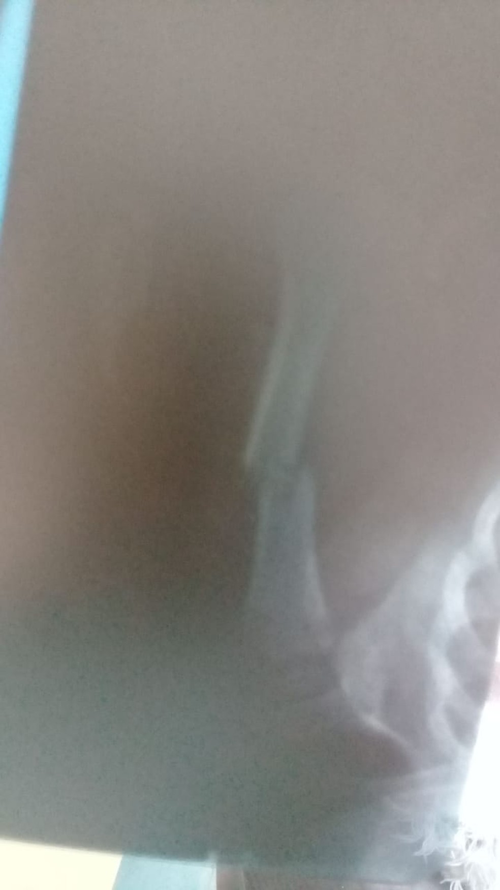 Bebê de Jundiaí teve fratura em um dos braços  — Foto: Arquivo pessoal