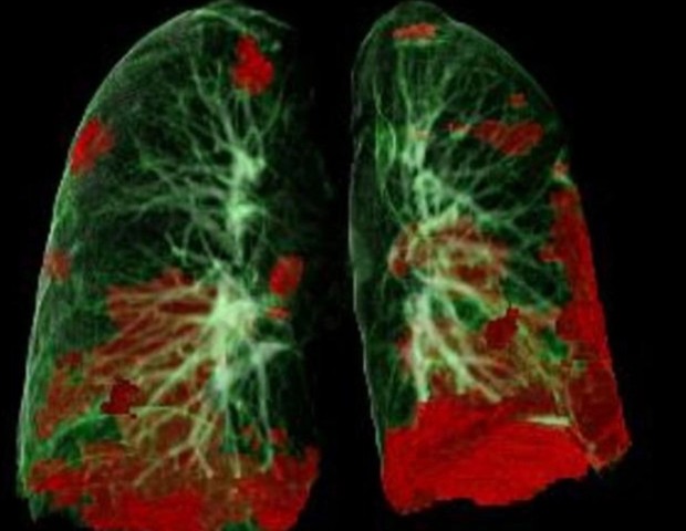 Tomografia computadorizada de um paciente com covid; o dano pulmonar está em vermelho (Foto: Gerlig Widmann e equipe, Departamento de Radiologia, Medical University of Innsbruck)