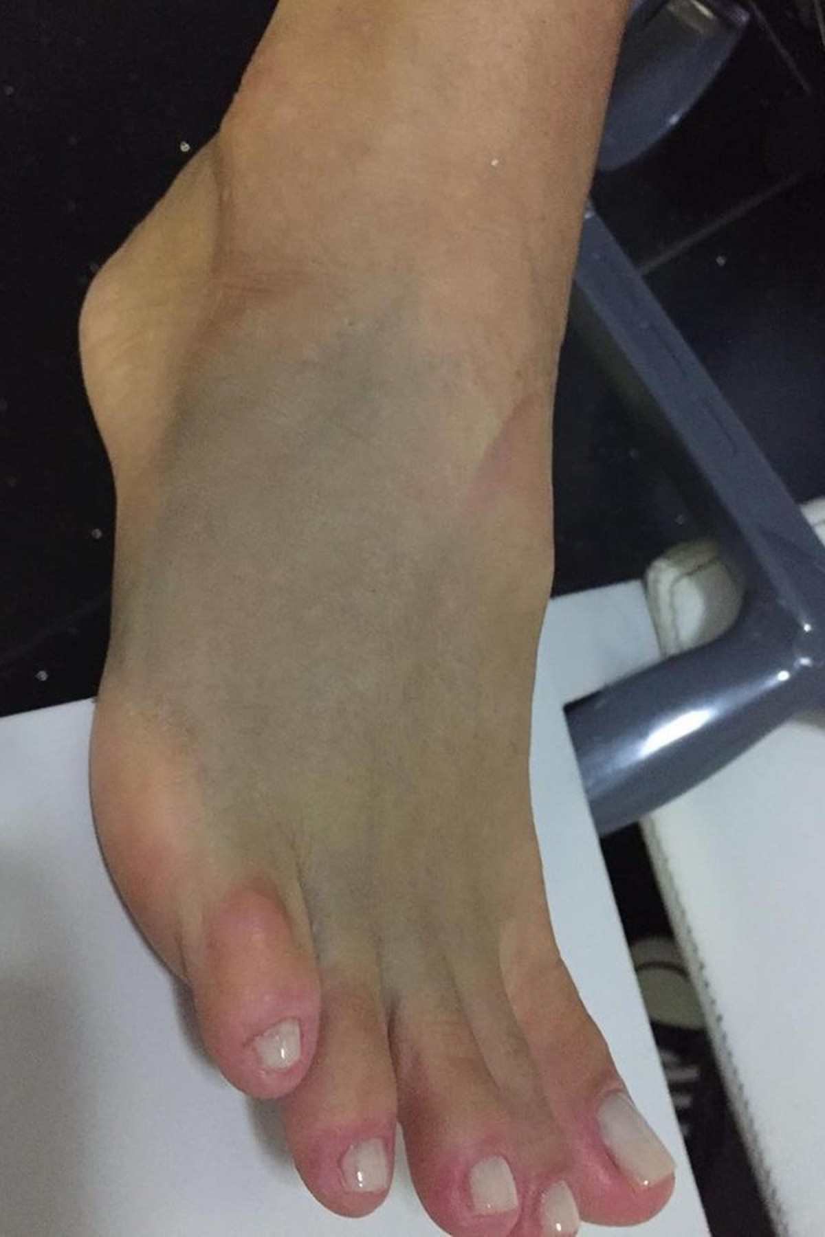 Xuxa posta foto do pé quebrado e diz: 