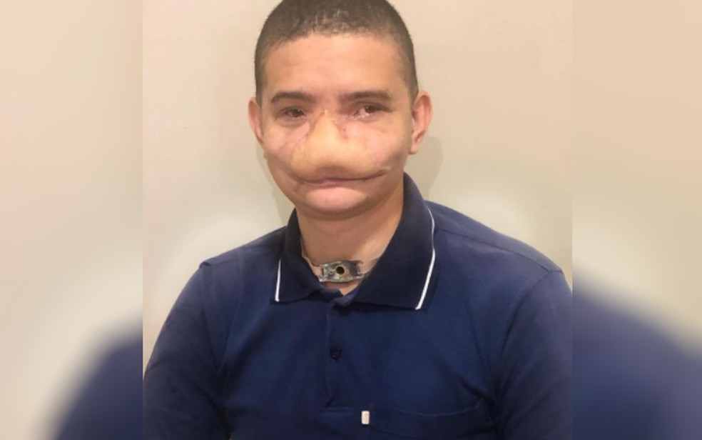 Jovem que perdeu parte do rosto ao ser atingido por fogos de artifício bomba na web ao contar sua história, em Trindade, Goiás — Foto: Reprodução/Instagram