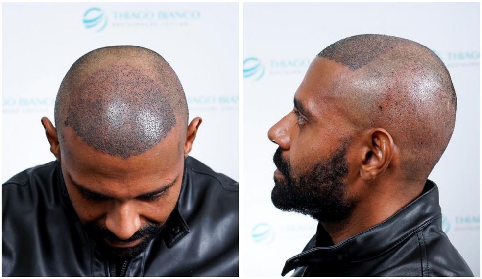 Pablo Faz Cirurgia De Transplante Capilar Muito Secador E Cremes Me Fizeram Ter Queda De Cabelo Famosos Gshow