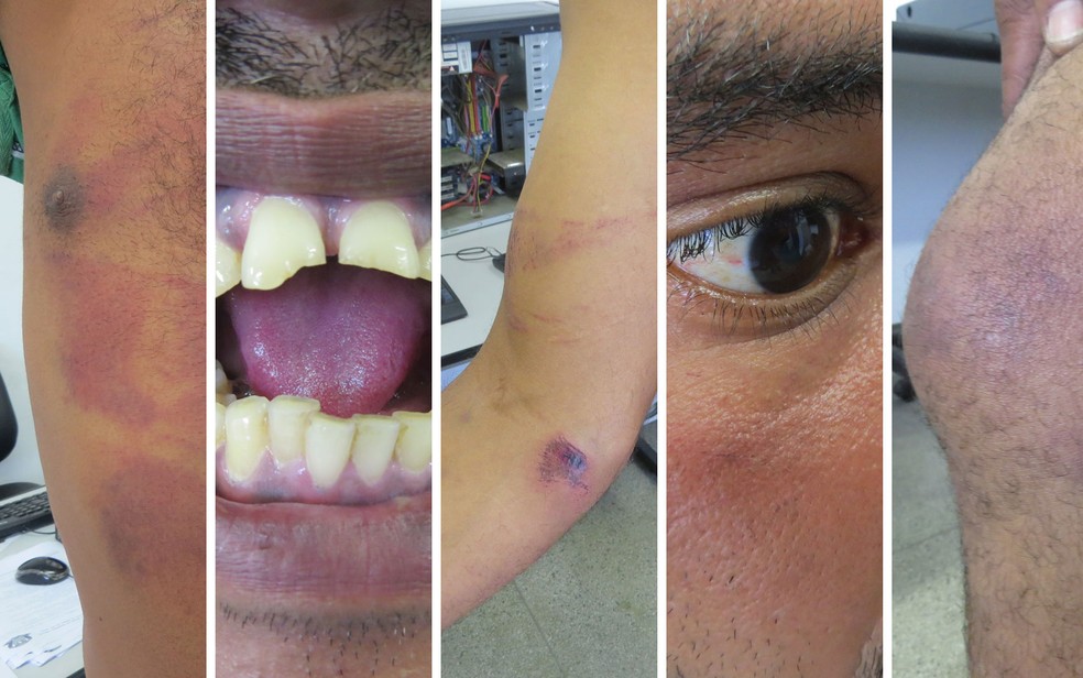 Fotos tiradas pela polícia mostram na pele do pedreiro as marcas da tortura que sofreu durante seu julgamento no 'tribunal do crime' em Guarulhos (Foto: Reprodução/Polícia Civil)