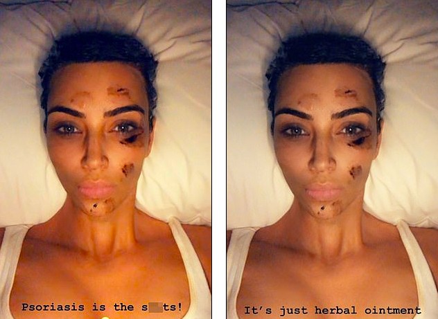 A foto compartilhada por Kim Kardashian mostrando o tratamento dela contra psoríase que causou comoção nas redes sociais (Foto: Instagram)
