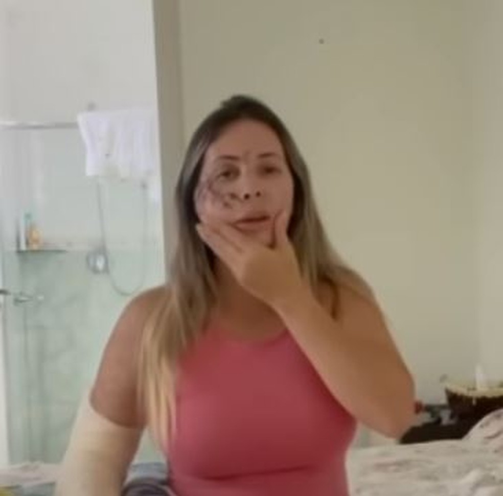 Aline mostrando o rosto após o acidente — Foto: Redes Sociais/ Reprodução 