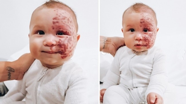 Os tratamentos deixam o rosto do pequeno Kingsley cheio de bolhas vermelhas (Foto: Reprodução/Kidspot)