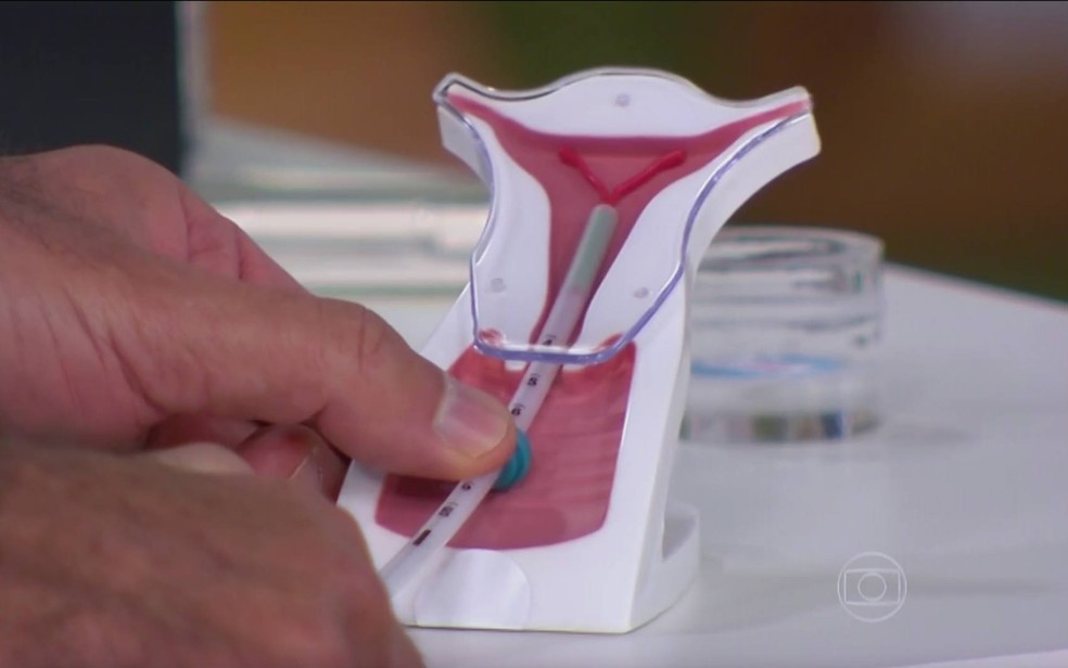 Dispositivo intrauterino (DIU) é um dos métodos contraceptivos alternativos aos hormonais (Foto: TV Globo/Reprodução)