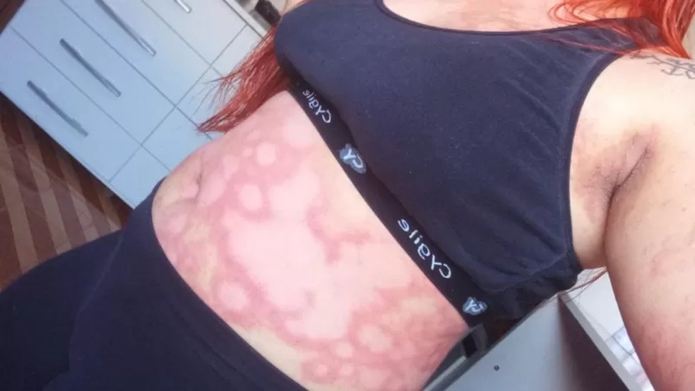 A psoríase provoca o aparecimento de manchas e causava coceira intensa e descamação da pele. — Foto: Arquivo pessoal via BBC