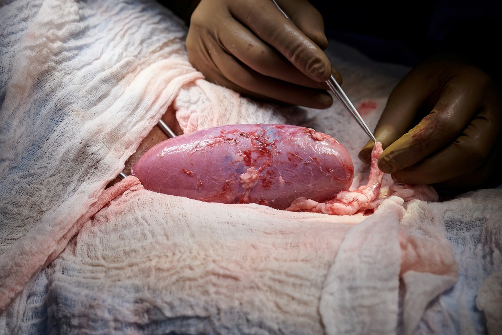 Em feito inédito, cirurgiões dos EUA testam com sucesso transplante de rim de porco em humano 13