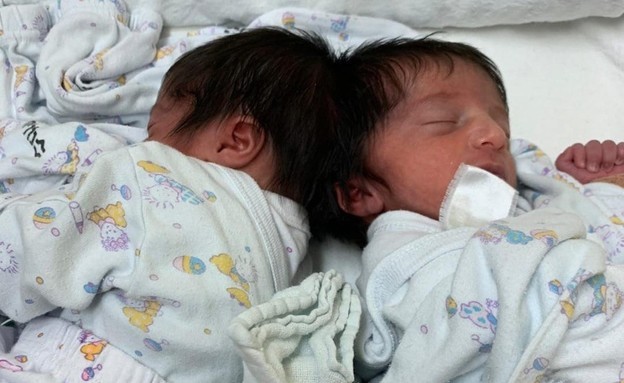 Essa é a primeira vez que um procedimento de separação de gêmeos siameses é feita em Israel (Foto: Reprodução/N12)